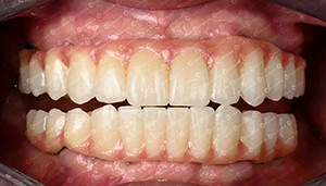 trường hợp công ty mới nhất về Trường hợp khách hàng. 4D Zirconia Block