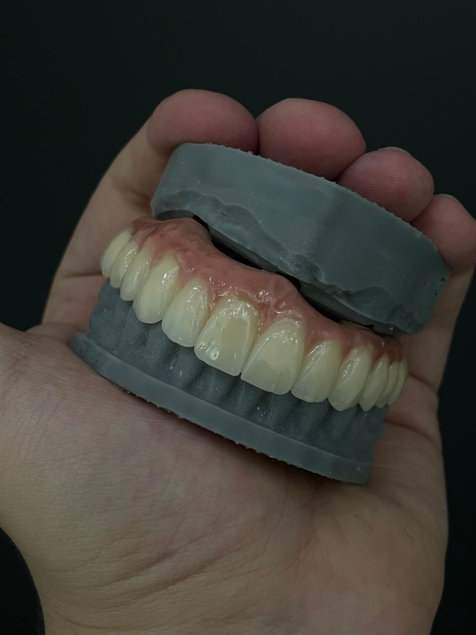 trường hợp công ty mới nhất về Đạt được vẻ đẹp tự nhiên với Zirconia: Một trường hợp phục hồi toàn bộ vòm miệng thành công từ Brazil