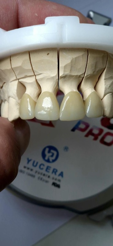 Yucera 4D Pro Zirconia Dental Whole Sale Multilayer Zirconium Disc Ceramic  for Cad Cam High Transmittance