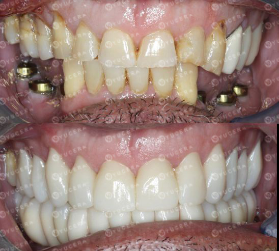 Yucera 4D Pro Zirconium Discs Reliable and Precise Dental Restoration Tools