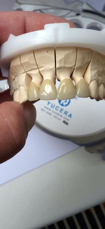 Yucera ST color Dental Zirconia Blocks - Ideal for Precise Dental Restorations